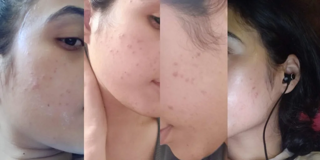 acne skin