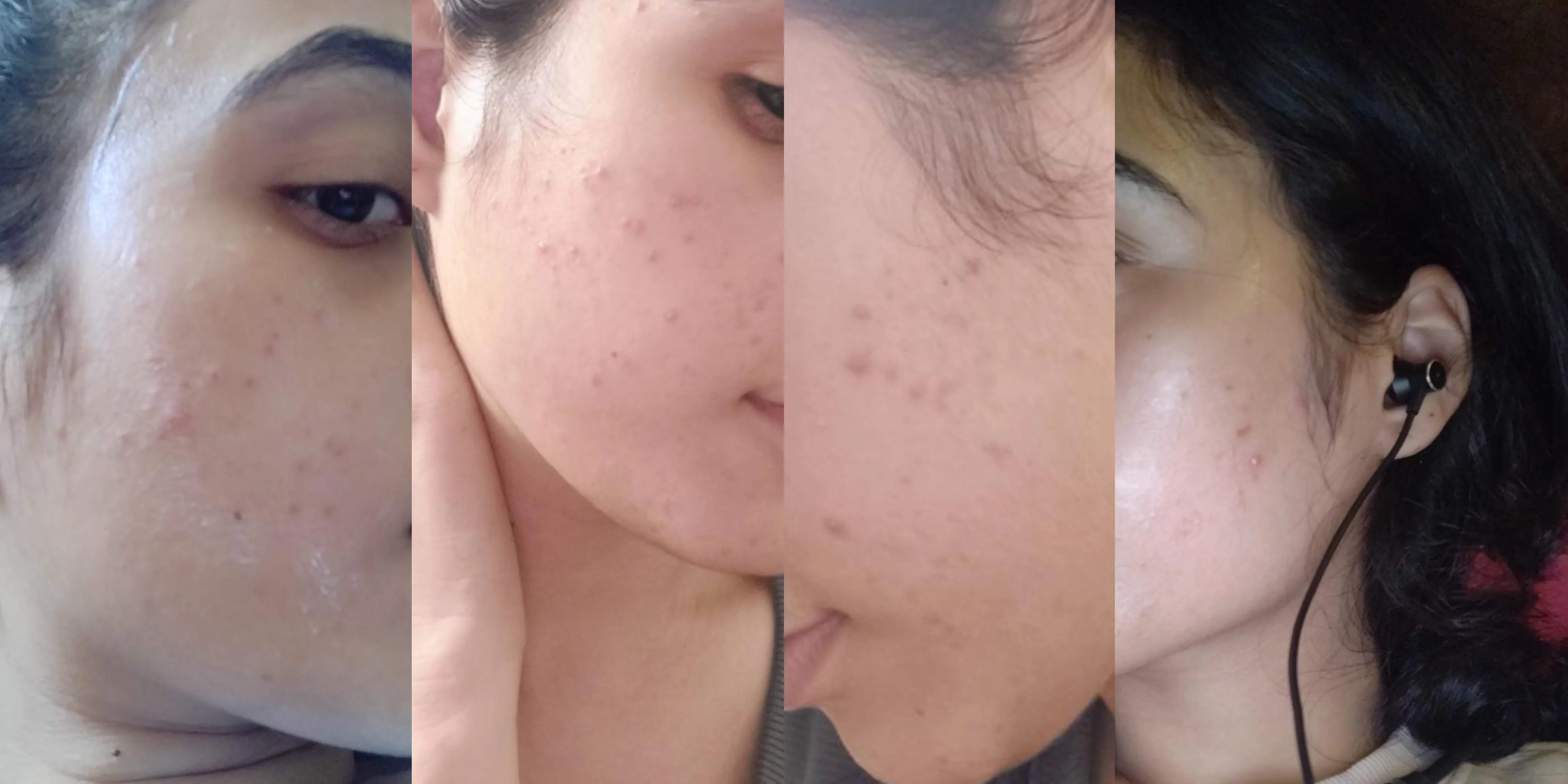 My Honest Acne Journey: Pimple Treatment Solution